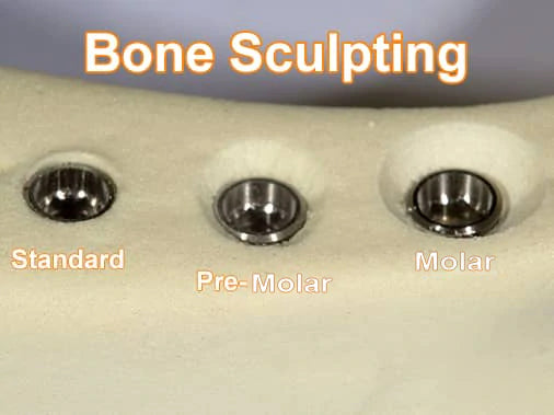 Bone Sculpting
